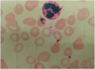 Hashimoto's thyroiditis, vitiligo, anemia, pituitary hyperplasia, and lupus nephritis—A case report of autoimmune polyglandular syndrome type III C + D and literature review